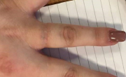 gallery/daisy after healed